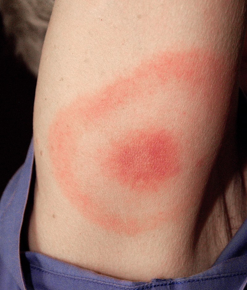 800px-Erythema_migrans_-_erythematous_rash_in_Lyme_disease_-_PHIL_9875